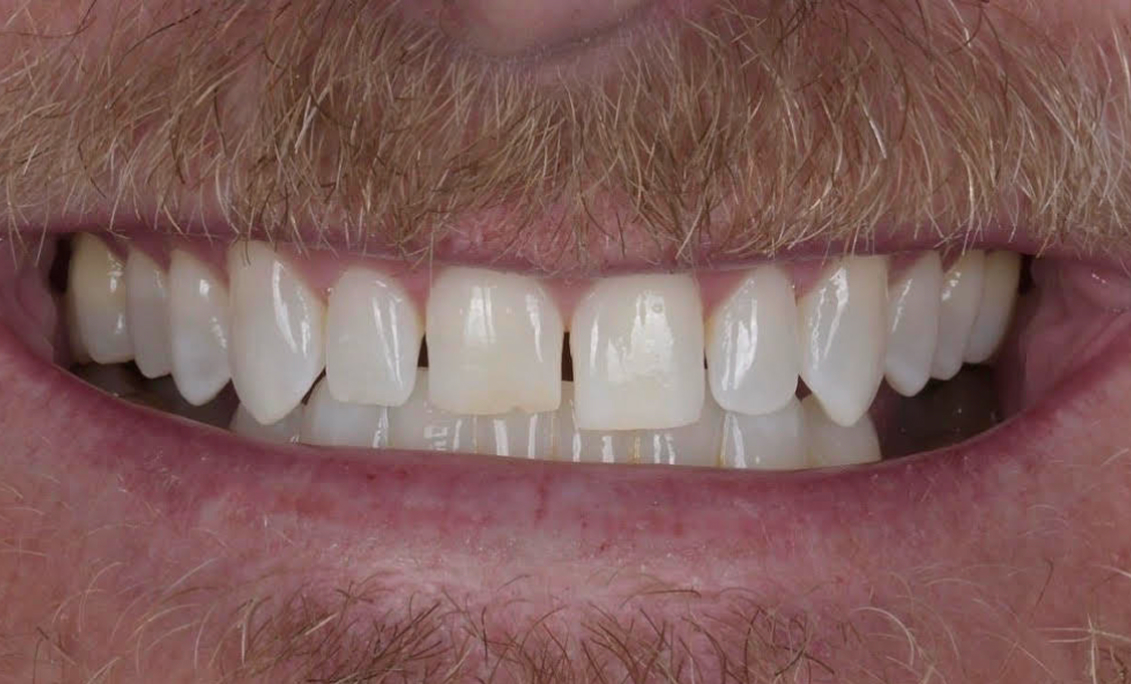 Before